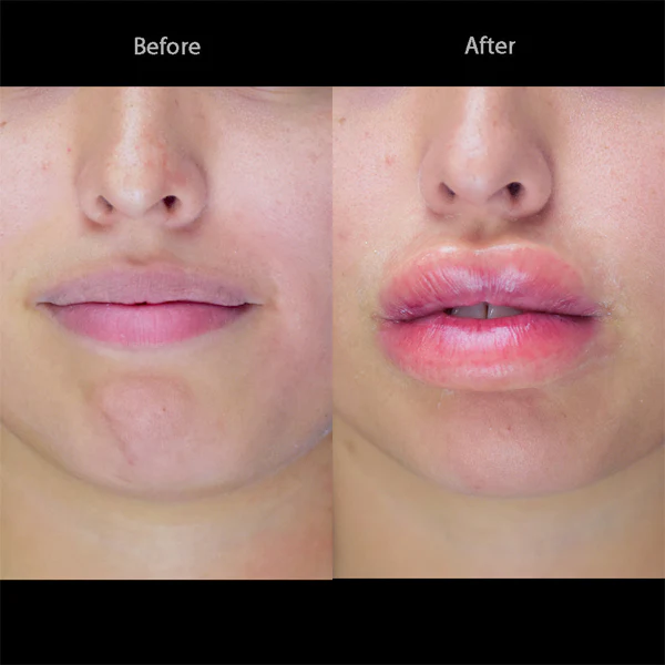 Peel N' Stick Prosthetics, Swollen Lips - Image 3