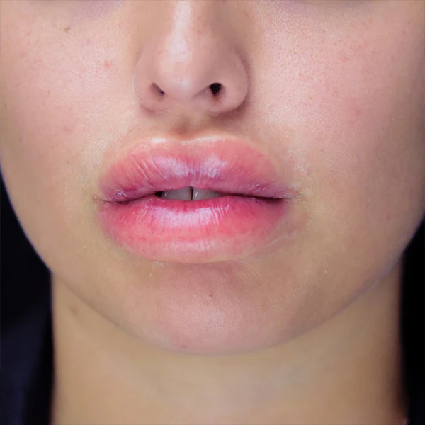 Peel N' Stick Prosthetics, Swollen Lips - Image 4